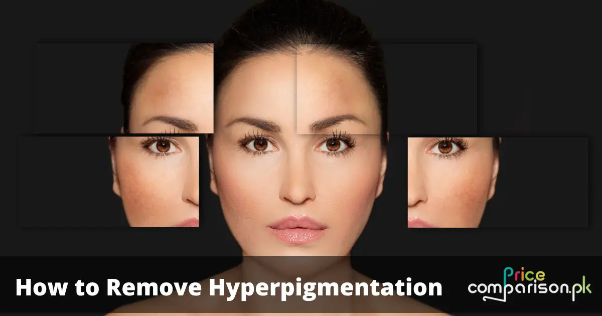 How to Remove Hyperpigmentation and Dark Spots